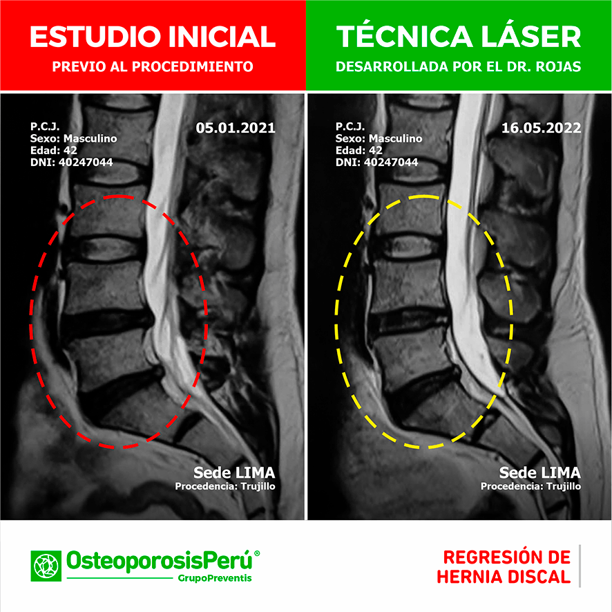 REGRESIÓN DE HERNIA DISCAL RX Osteoporosis Perú